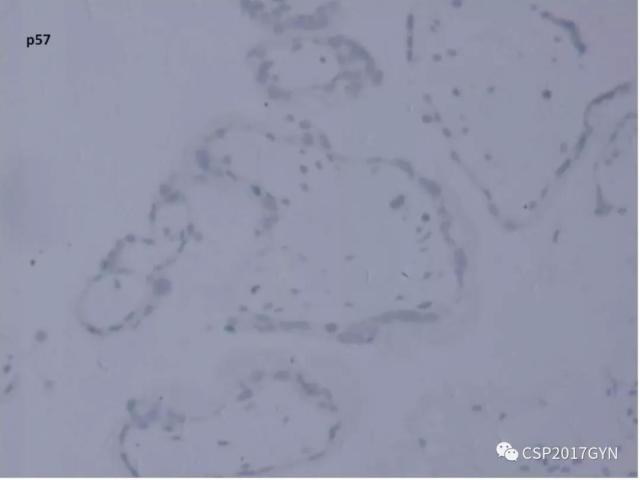 妊娠滋养细胞肿瘤的临床病理学进展