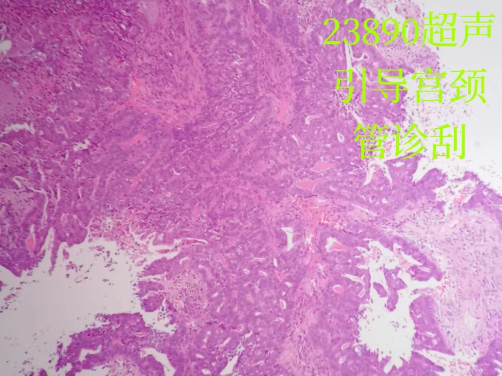 宫颈高级别鳞状上皮内病变并宫颈腺癌1例（八十八）