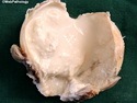 乳腺病理-炎症或反应性病变-乳汁潴留性囊肿