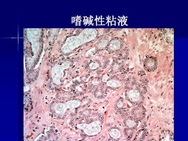 前列腺病理诊断线索（上）——黄教悌