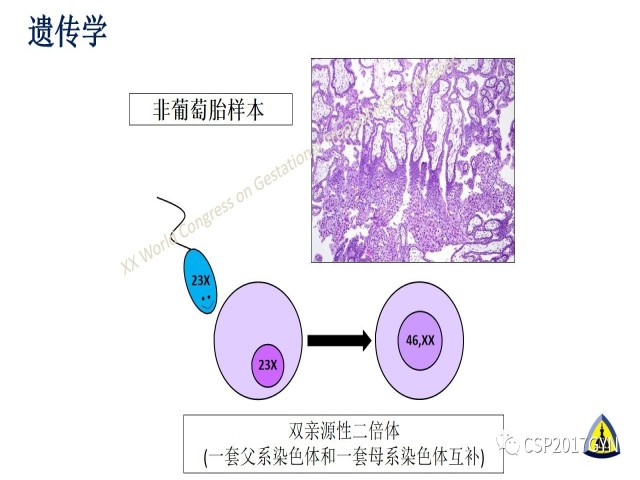 p57免疫组化染色及基因分型 在葡萄胎精确诊断中的应用
