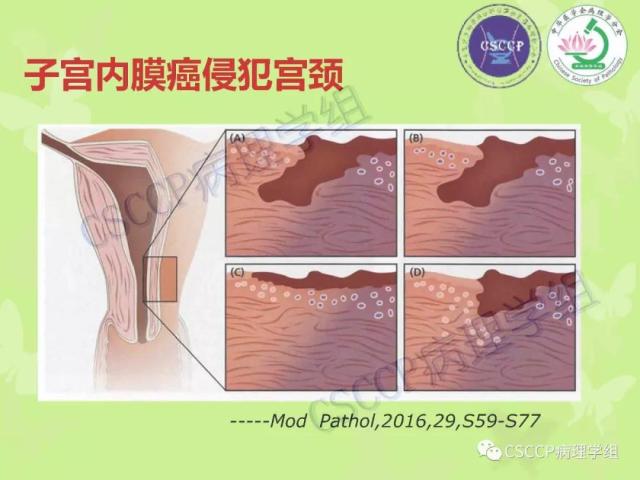 宫颈与子宫病变病理标本取材
