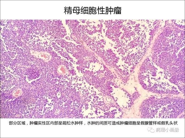 泌尿病理--精原细胞瘤VS精母细胞瘤