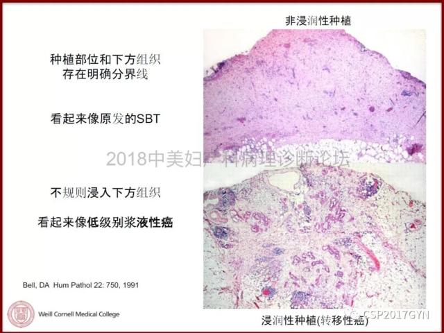 非粘液性卵巢肿瘤的诊断挑战