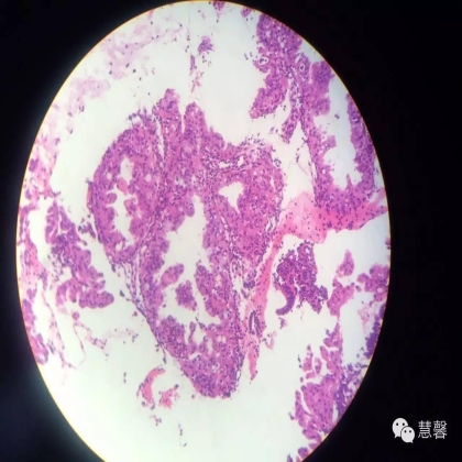子宫内膜乳头状增生（甜甜分享病例，孔祥田(Max)*Roswell*老师讲解，kent翻译整理文献）
