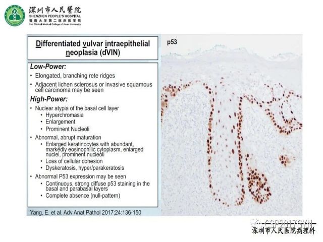 2019USCAP妇科病理热点介绍