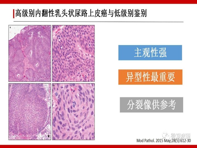 泌尿课程/非浸润性尿路上皮肿瘤诊断公式