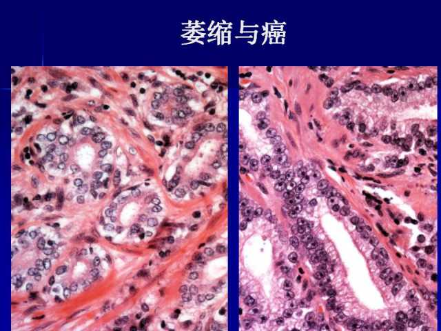 前列腺病理诊断线索（下）——黄教悌