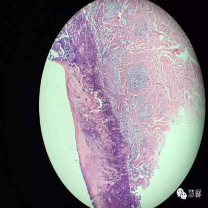 Acquired perforating dermatosis（孔祥田(Max)*Roswell*NM]分享及讲解）