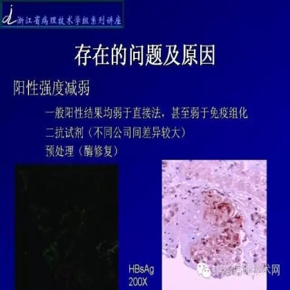 探讨免疫组织学在肾穿标本中的应用