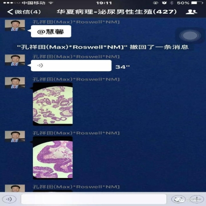低度恶性潜能尿路上皮乳头状瘤？低级别尿路上皮癌？（孔祥田(Max)*Roswell*讲解）