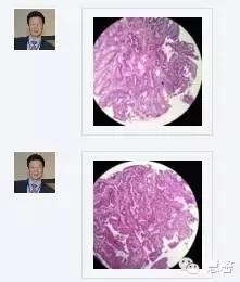 结、直肠管绒毛状腺瘤-高级别病变诊断等相关问题2（悄悄分享、孔祥田(Max)*Roswell*老师讲解）