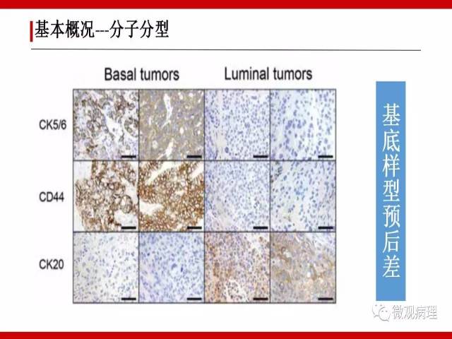 泌尿课程/浸润性尿路上皮癌病理学类型