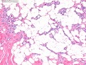 乳腺病理-乳腺良性增生-微腺性腺病