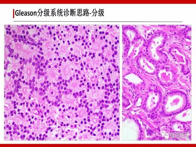 前列腺癌Gleason分级系统的前世今生