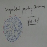 Breast Papillary Les