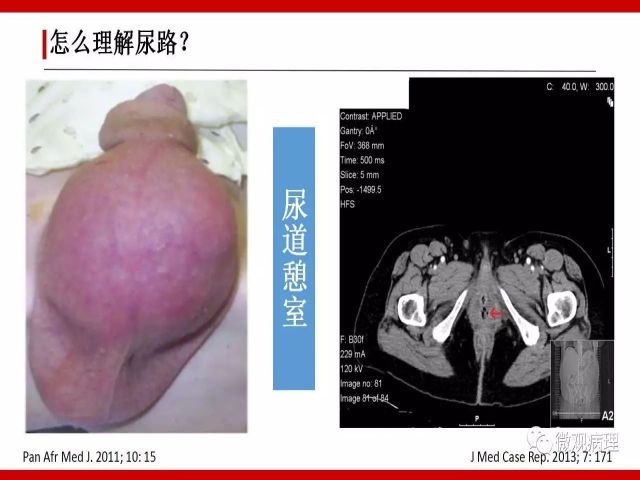 泌尿课程/尿路腺样病变的诊断要点