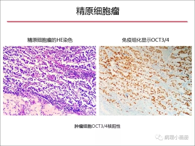 泌尿病理--精原细胞瘤VS精母细胞瘤