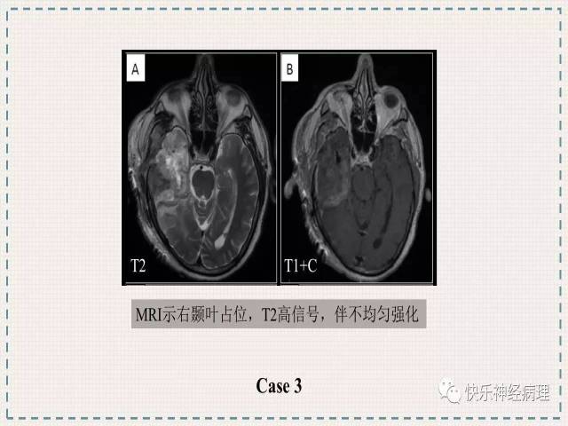 胶质瘤分子结果矛盾时如何整合诊断