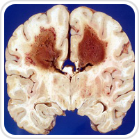 Webpathology.com-镜像翻译（自学使用，版权归原网站所有）