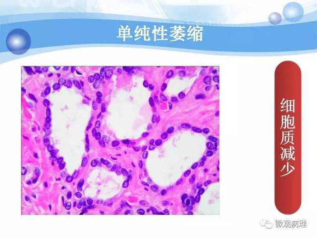 泌尿课程/局灶性前列腺萎缩