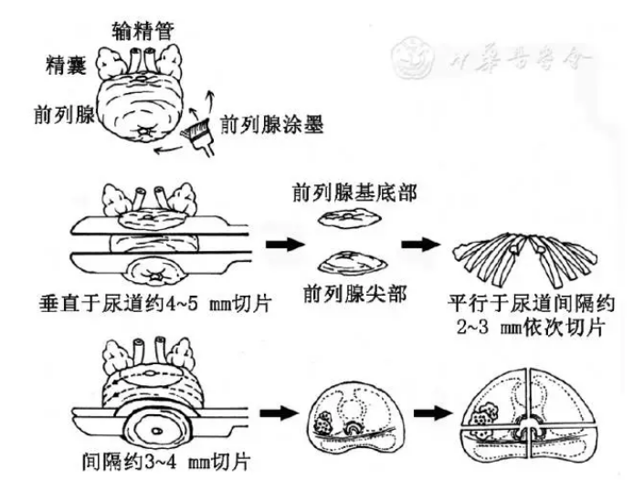 前列腺取材心得 前列腺取材心得
