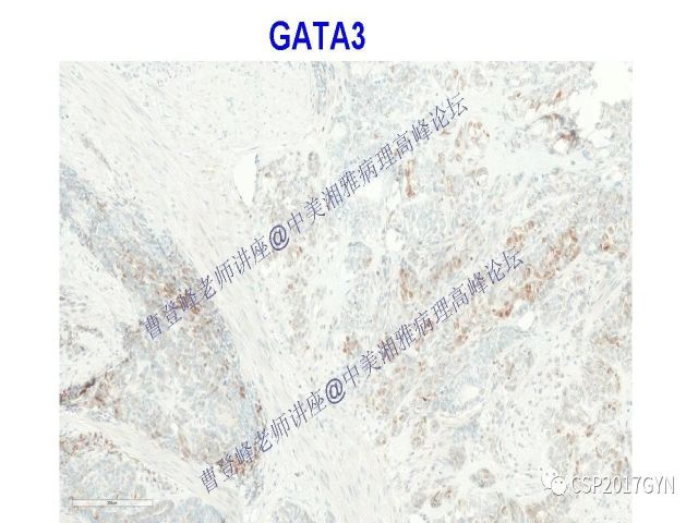 妇科肿瘤病理新进展——特殊类型的腺癌