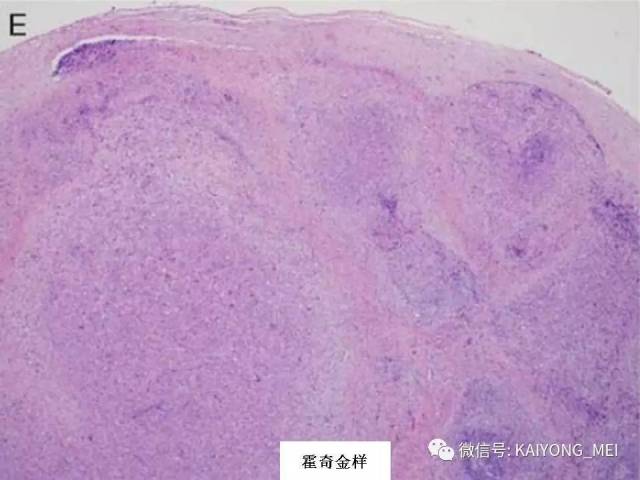 T细胞淋巴瘤病理诊断及进展（一）
