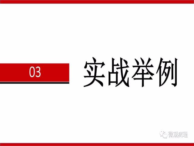 前列腺癌Gleason分级系统的前世今生