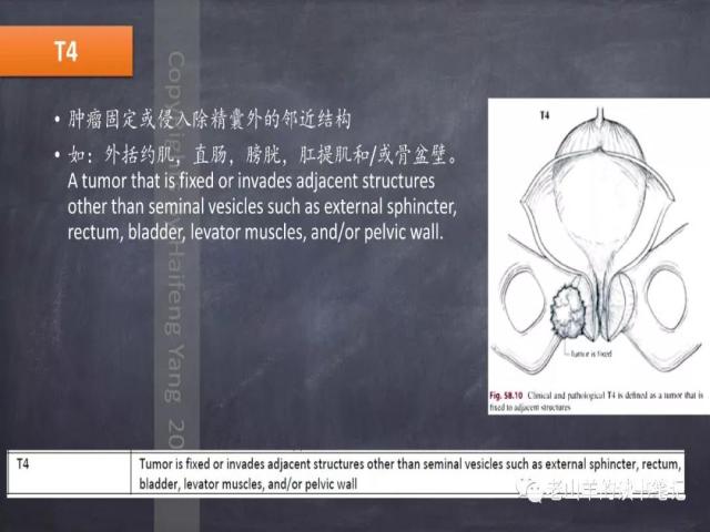 AJCC第8版 前列腺癌分期 之 病理学要点