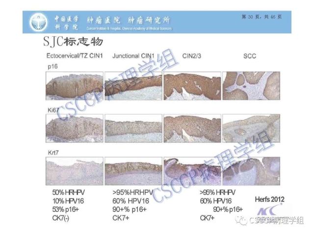 宫颈癌前病变中的诊断难点及阴道镜中ECC的 应用价值