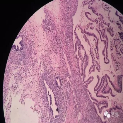 交界性黏液性囊腺瘤？癌？（魏娉分享，刘从容老师讲解）