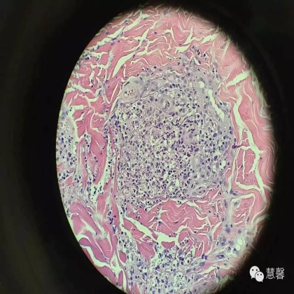 Acquired perforating dermatosis（孔祥田(Max)*Roswell*NM]分享及讲解）