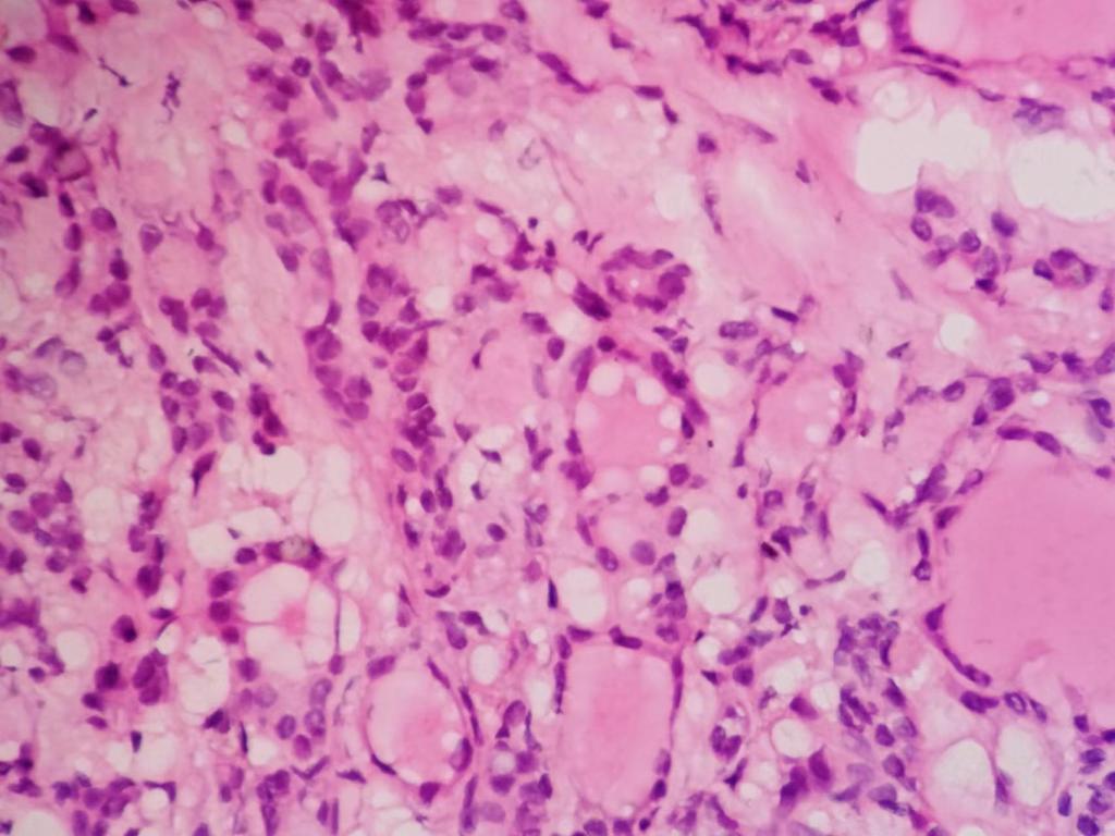 不典型的甲状腺乳头状癌？（札记八十）