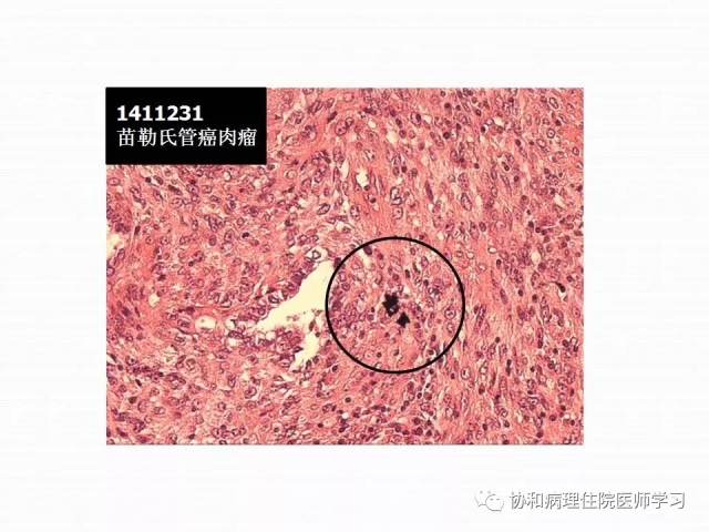 病理学基础知识 : 核分裂像的识别