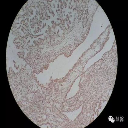 透明细胞乳头状肾细胞癌？TFE3 Traslocation Carcinoma？（赵洋分享，孔祥田(Max)*NM老师讲解）