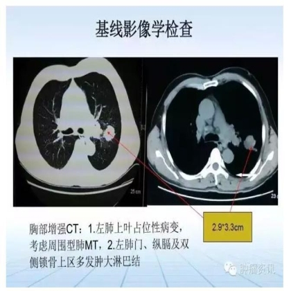 中日韩个体化诊疗案例大赛经典赏析之二——TKI治疗耐药二次活检发现SCLC转化临床病例