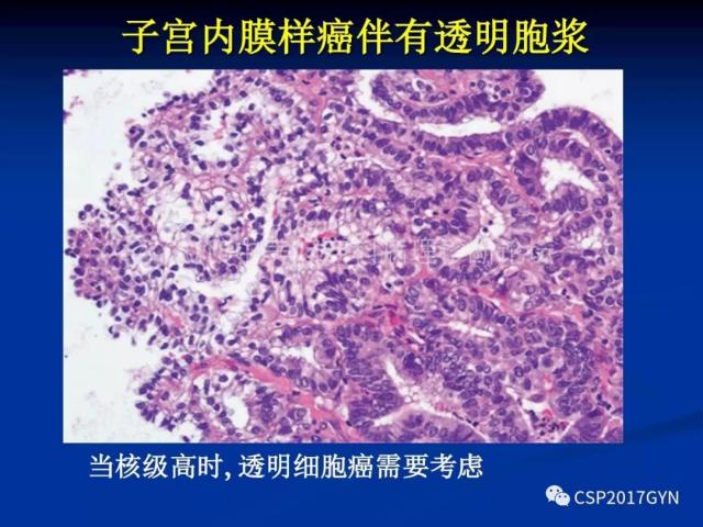 子宫内膜癌：诊断与进展