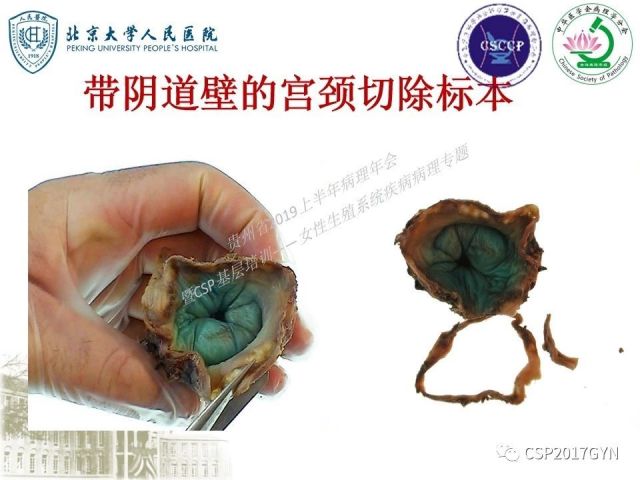 中华病理学会基层培训遵义站讲座（三）——宫颈鳞状上皮病变的病理诊断与鉴别诊断
