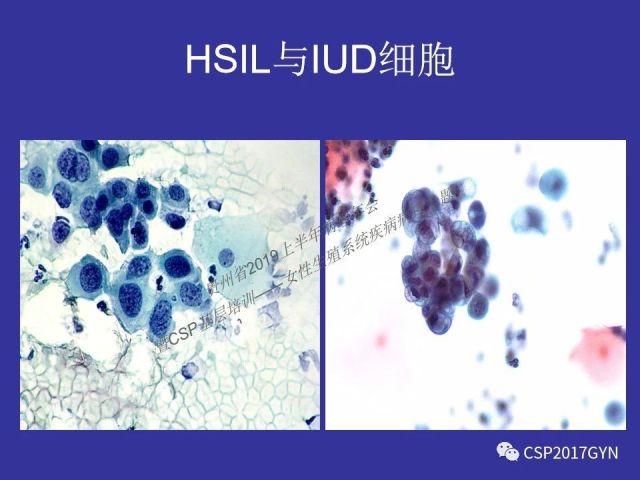 中华病理学会基层培训遵义站讲座（二）——宫颈细胞学诊断中陷阱与筛查进展