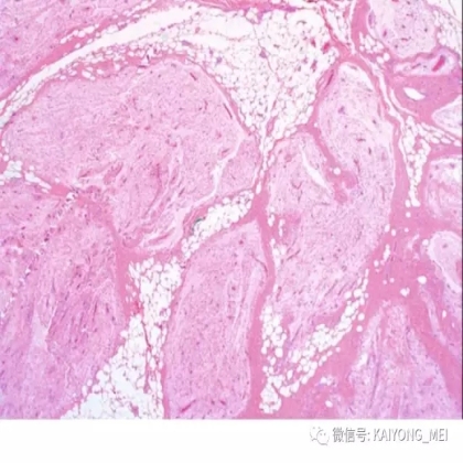 女性生殖道软组织肿瘤病理诊断及进展（二）