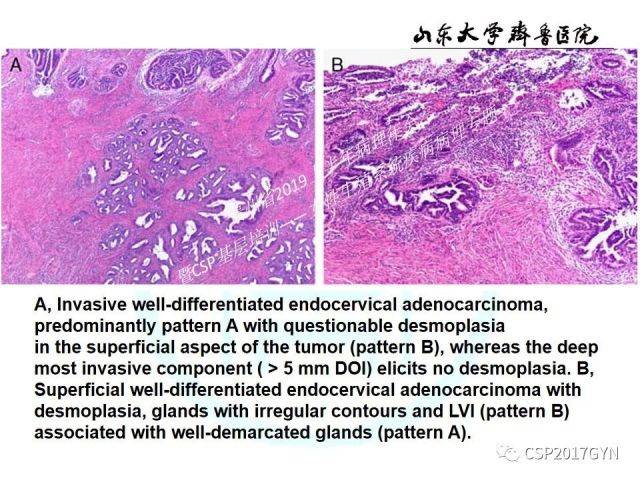 中华病理学会基层培训遵义站讲座（四）——宫颈腺癌的诊断及新分型