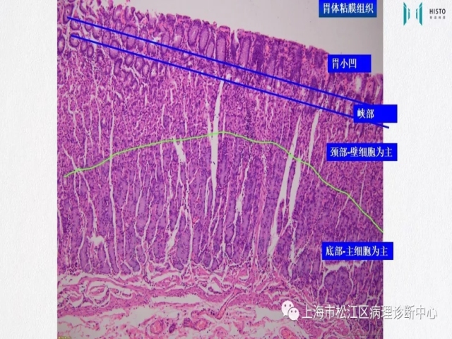 上消化道早癌病理诊断中的困惑及基本对策回顾