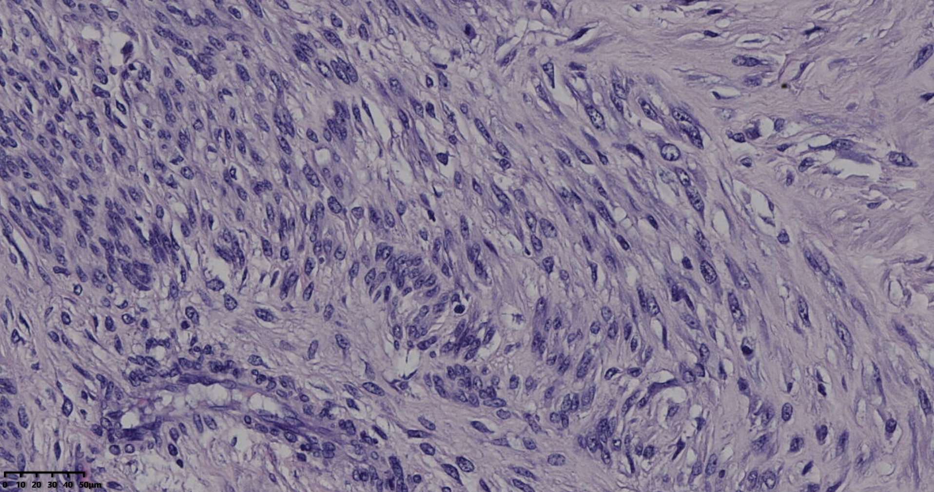 子宫多发性平滑肌瘤伴肉瘤