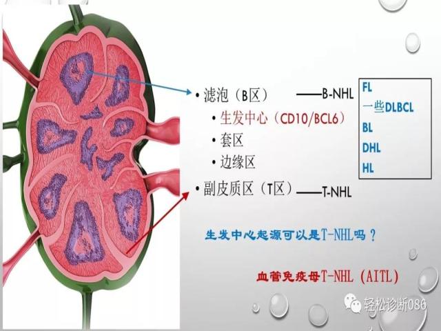 血管免疫母T细胞淋巴瘤的病理诊断