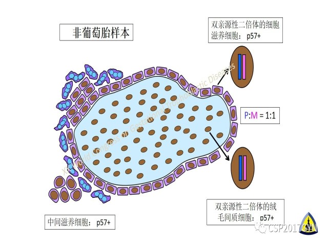 p57免疫组化染色及基因分型 在葡萄胎精确诊断中的应用
