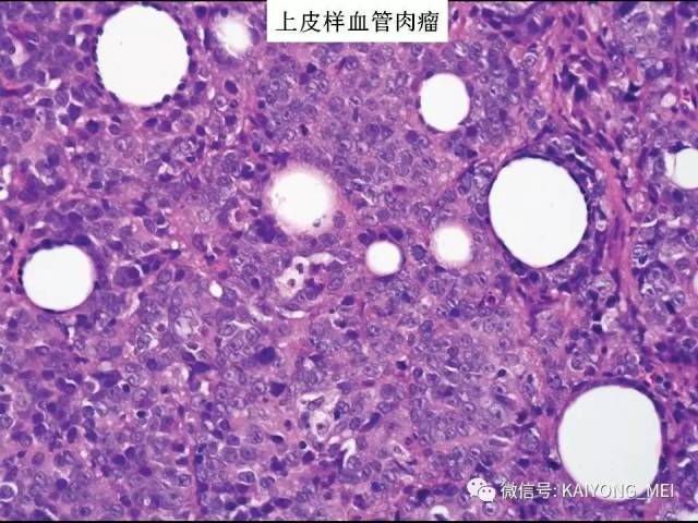 乳腺梭形细胞病变的病理诊断及进展（二）