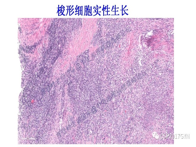 妇科肿瘤病理新进展——特殊类型的腺癌