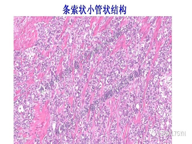 妇科肿瘤病理新进展——特殊类型的腺癌