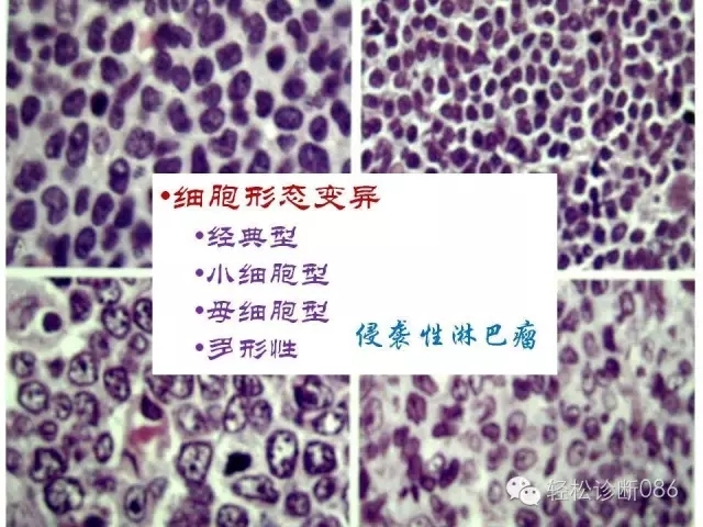 关于套细胞淋巴瘤的总结课件